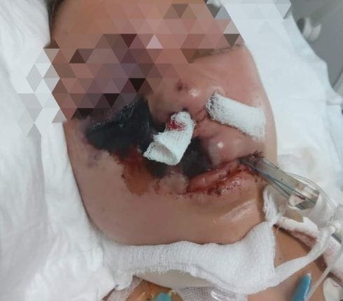 Alerta por paciente con Hongo Negro en Hospital Civil de Tampico; familia pide apoyo.